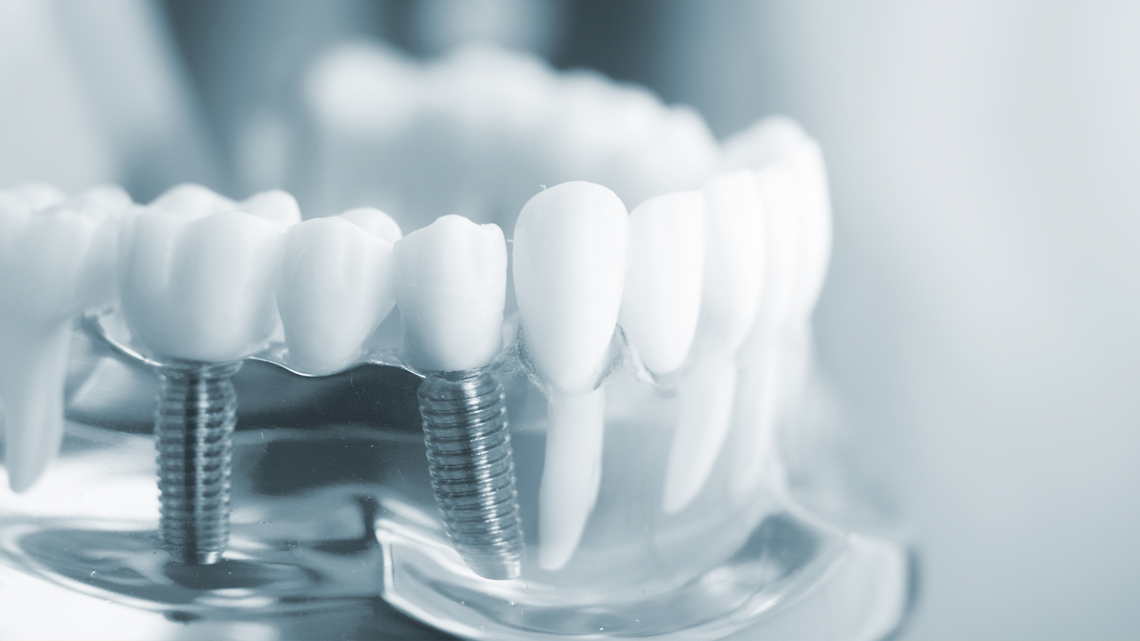 Implantate setzen einfach erklärt: So funktioniert die Implantation